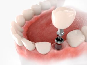 implantes dentários