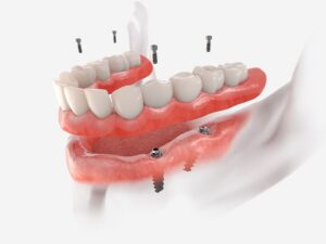 próteses dentárias